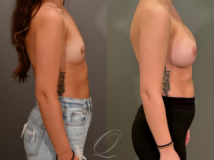 Breast Augmentation Case 1001867 Before & After Right Side | Serving Rochester, Syracuse & Buffalo, NY | Quatela Center for Plastic Surgery