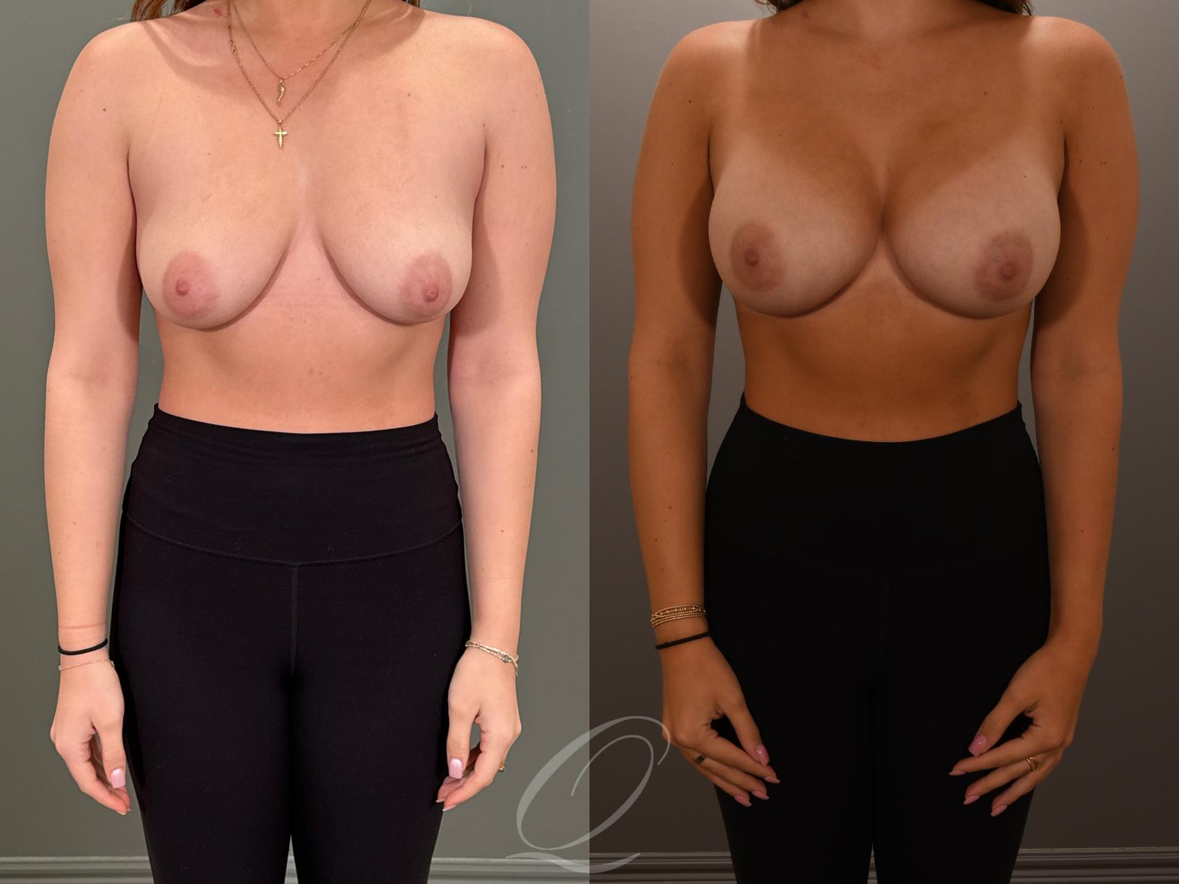Breast Augmentation Case 1001878 Before & After Front | Serving Rochester, Syracuse & Buffalo, NY | Quatela Center for Plastic Surgery