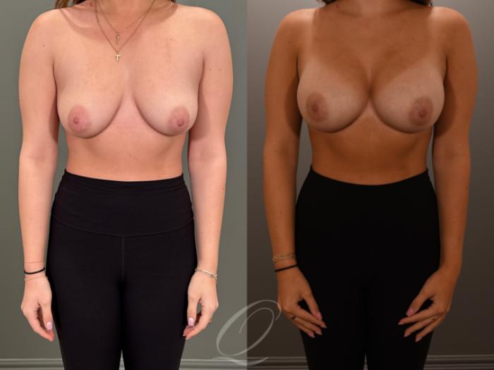 Breast Augmentation Case 1001878 Before & After Front | Serving Rochester, Syracuse & Buffalo, NY | Quatela Center for Plastic Surgery