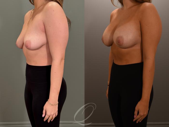 Breast Augmentation Case 1001878 Before & After Left Oblique | Serving Rochester, Syracuse & Buffalo, NY | Quatela Center for Plastic Surgery