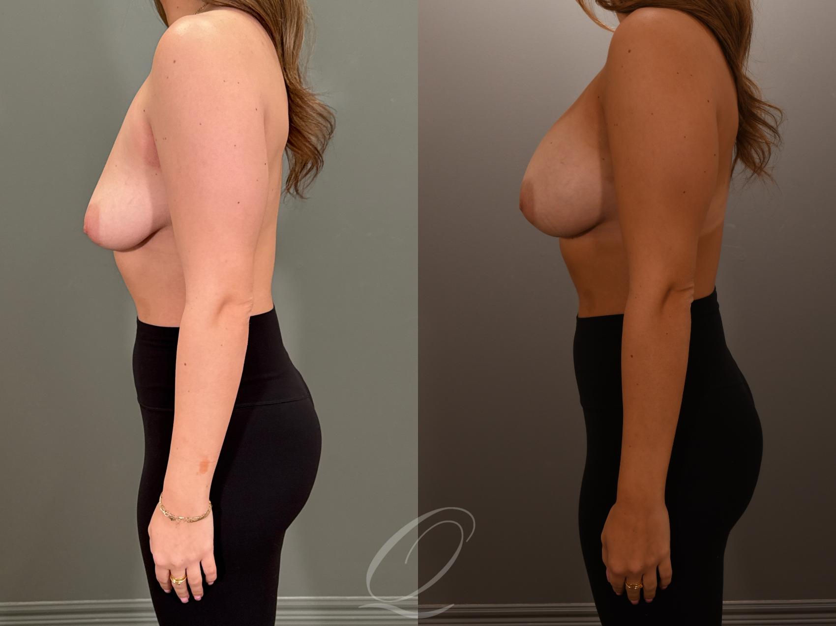 Breast Augmentation Case 1001878 Before & After Left Side | Serving Rochester, Syracuse & Buffalo, NY | Quatela Center for Plastic Surgery