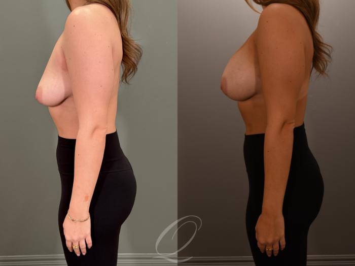 Breast Augmentation Case 1001878 Before & After Left Side | Serving Rochester, Syracuse & Buffalo, NY | Quatela Center for Plastic Surgery