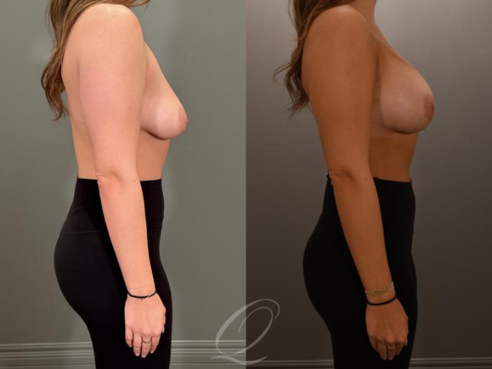 Breast Augmentation Case 1001878 Before & After Right Side | Serving Rochester, Syracuse & Buffalo, NY | Quatela Center for Plastic Surgery