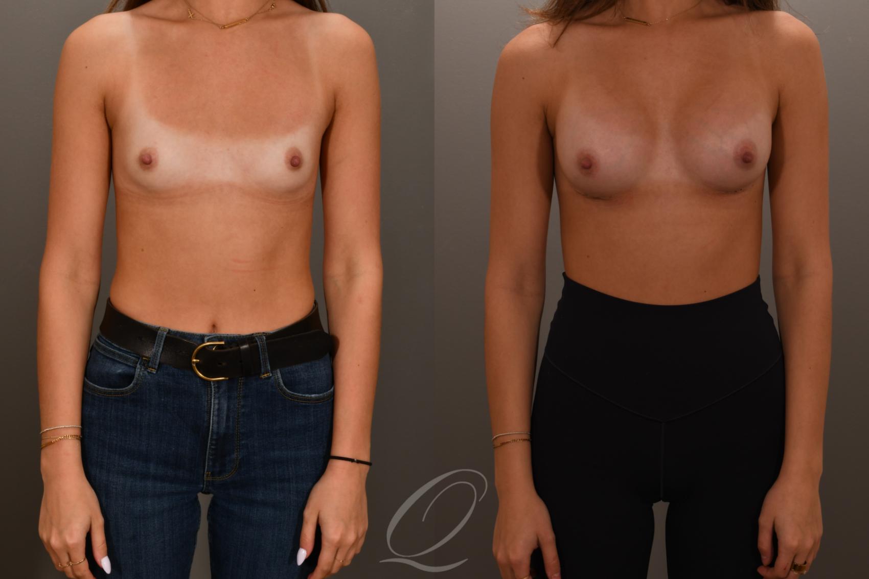 Breast Augmentation Case 1001879 Before & After Front | Serving Rochester, Syracuse & Buffalo, NY | Quatela Center for Plastic Surgery