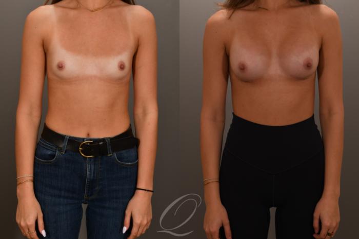 Breast Augmentation Case 1001879 Before & After Front | Serving Rochester, Syracuse & Buffalo, NY | Quatela Center for Plastic Surgery