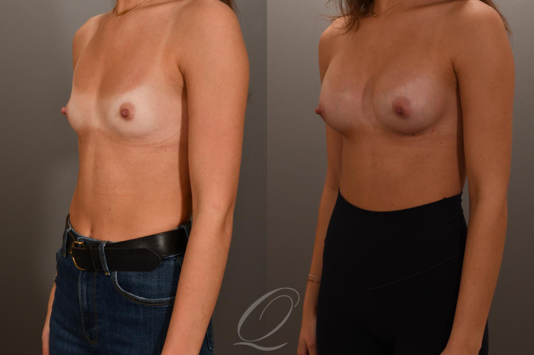 Breast Augmentation Case 1001879 Before & After Left Oblique | Serving Rochester, Syracuse & Buffalo, NY | Quatela Center for Plastic Surgery
