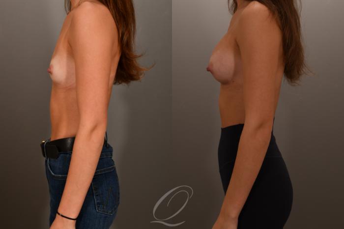 Breast Augmentation Case 1001879 Before & After Left Side | Serving Rochester, Syracuse & Buffalo, NY | Quatela Center for Plastic Surgery