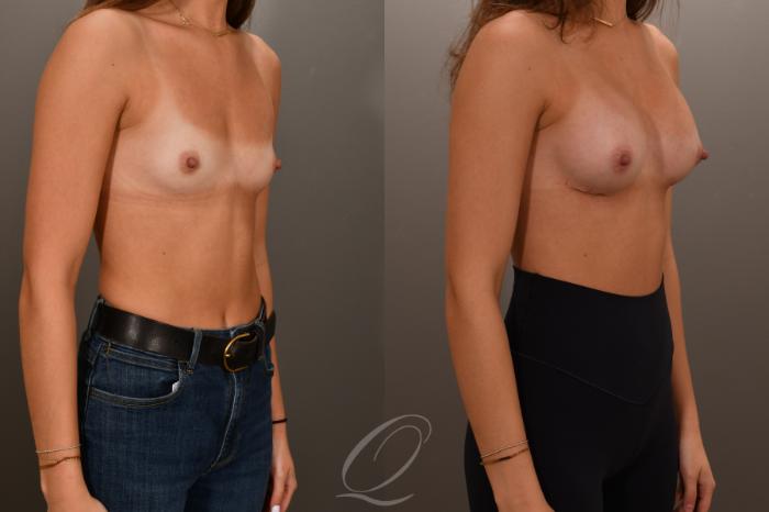 Breast Augmentation Case 1001879 Before & After Right Oblique | Serving Rochester, Syracuse & Buffalo, NY | Quatela Center for Plastic Surgery