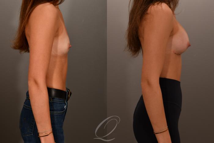 Breast Augmentation Case 1001879 Before & After Right Side | Serving Rochester, Syracuse & Buffalo, NY | Quatela Center for Plastic Surgery