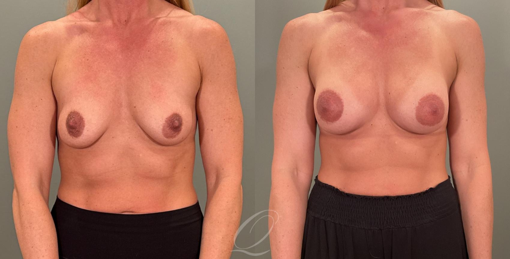 Breast Augmentation Case 1001880 Before & After Front | Serving Rochester, Syracuse & Buffalo, NY | Quatela Center for Plastic Surgery