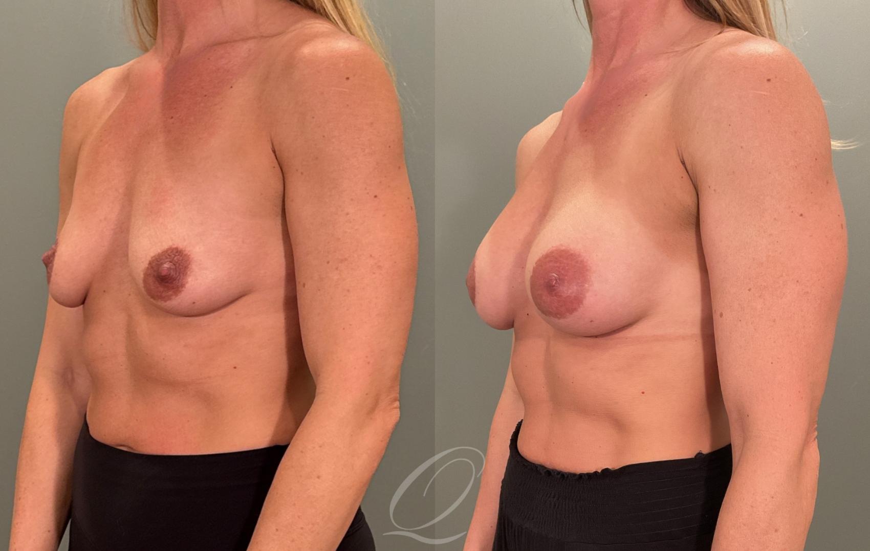 Breast Augmentation Case 1001880 Before & After Left Oblique | Serving Rochester, Syracuse & Buffalo, NY | Quatela Center for Plastic Surgery