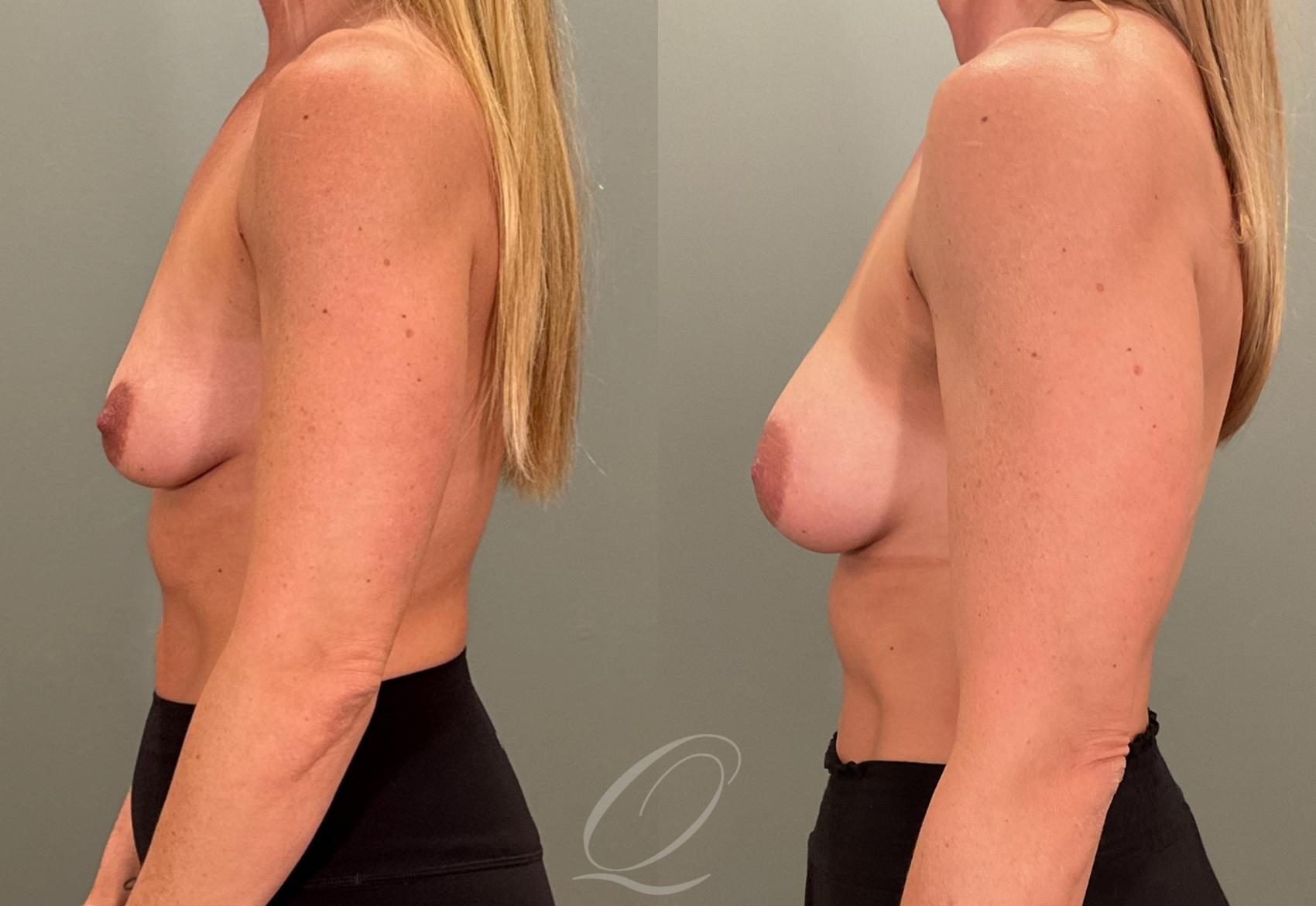 Breast Augmentation Case 1001880 Before & After Left Side | Serving Rochester, Syracuse & Buffalo, NY | Quatela Center for Plastic Surgery