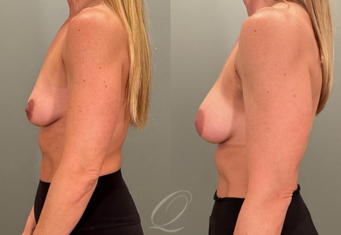 Breast Augmentation Case 1001880 Before & After Left Side | Serving Rochester, Syracuse & Buffalo, NY | Quatela Center for Plastic Surgery