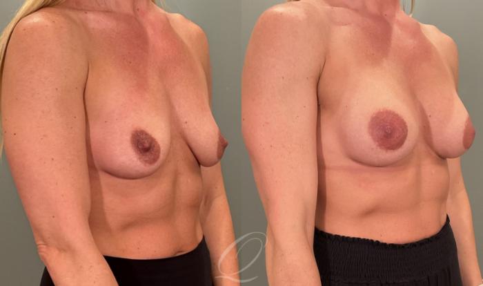 Breast Augmentation Case 1001880 Before & After Right Oblique | Serving Rochester, Syracuse & Buffalo, NY | Quatela Center for Plastic Surgery