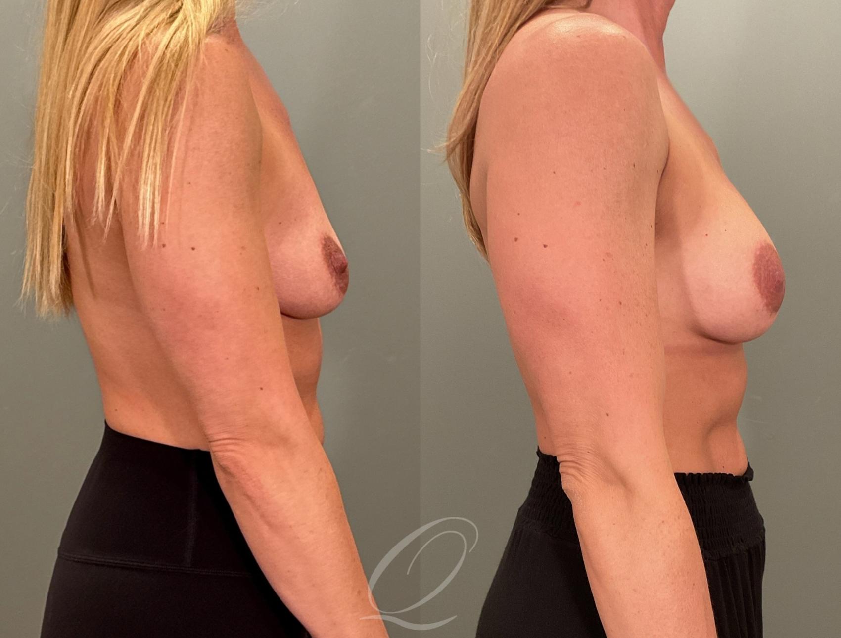 Breast Augmentation Case 1001880 Before & After Right Side | Serving Rochester, Syracuse & Buffalo, NY | Quatela Center for Plastic Surgery