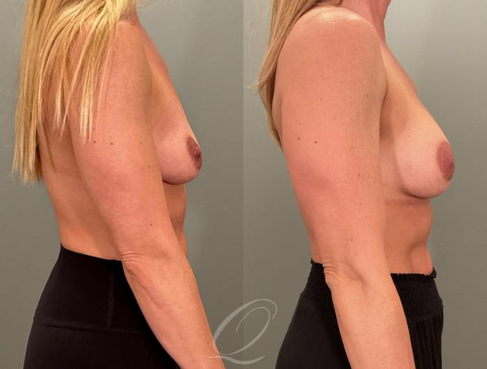 Breast Augmentation Case 1001880 Before & After Right Side | Serving Rochester, Syracuse & Buffalo, NY | Quatela Center for Plastic Surgery