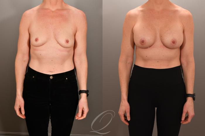 Breast Augmentation Case 1001892 Before & After Front | Serving Rochester, Syracuse & Buffalo, NY | Quatela Center for Plastic Surgery