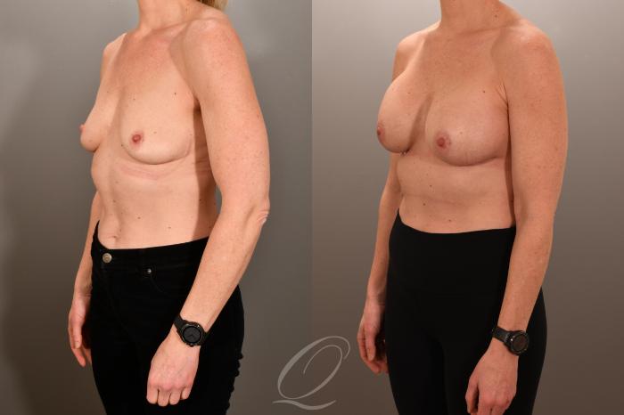 Breast Augmentation Case 1001892 Before & After Left Oblique | Serving Rochester, Syracuse & Buffalo, NY | Quatela Center for Plastic Surgery