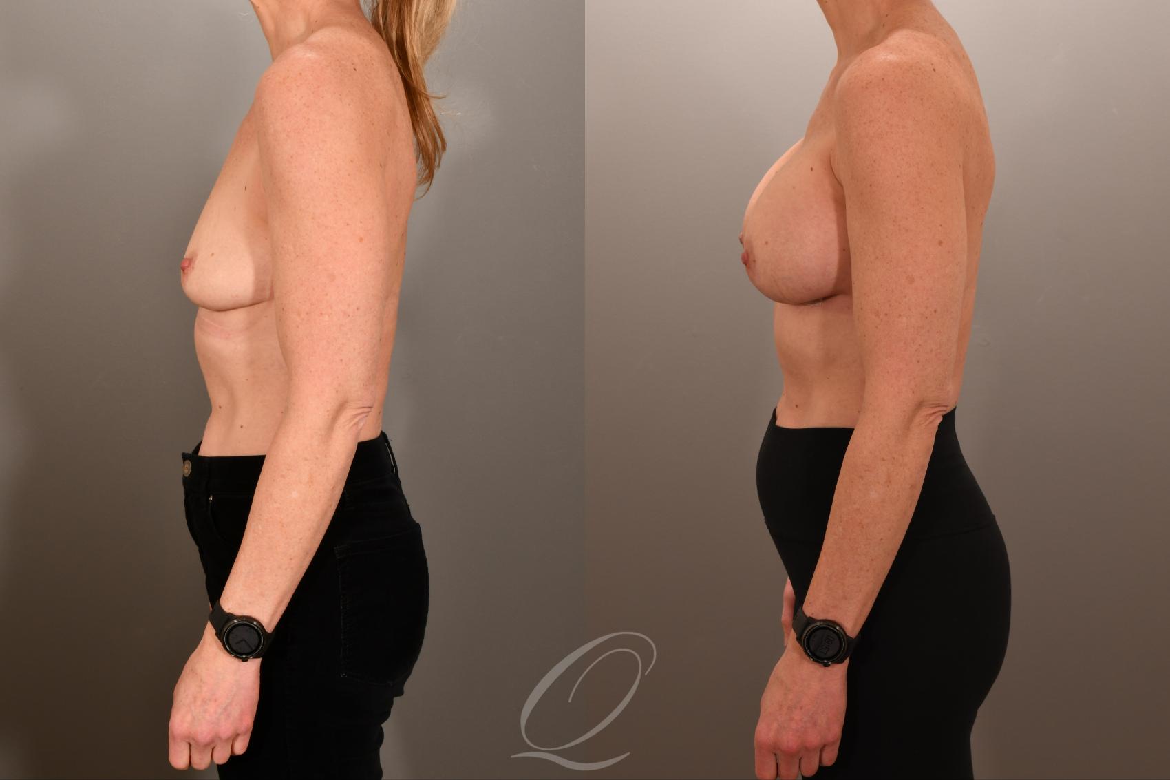 Breast Augmentation Case 1001892 Before & After Left Side | Serving Rochester, Syracuse & Buffalo, NY | Quatela Center for Plastic Surgery