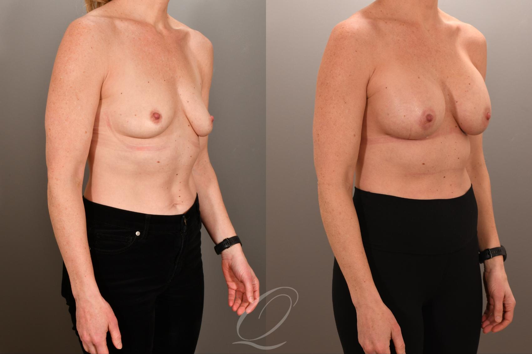 Breast Augmentation Case 1001892 Before & After Right Oblique | Serving Rochester, Syracuse & Buffalo, NY | Quatela Center for Plastic Surgery