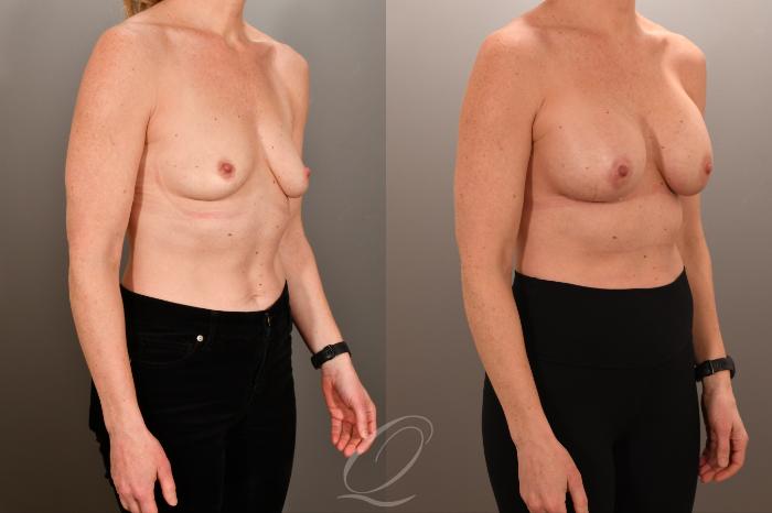 Breast Augmentation Case 1001892 Before & After Right Oblique | Serving Rochester, Syracuse & Buffalo, NY | Quatela Center for Plastic Surgery