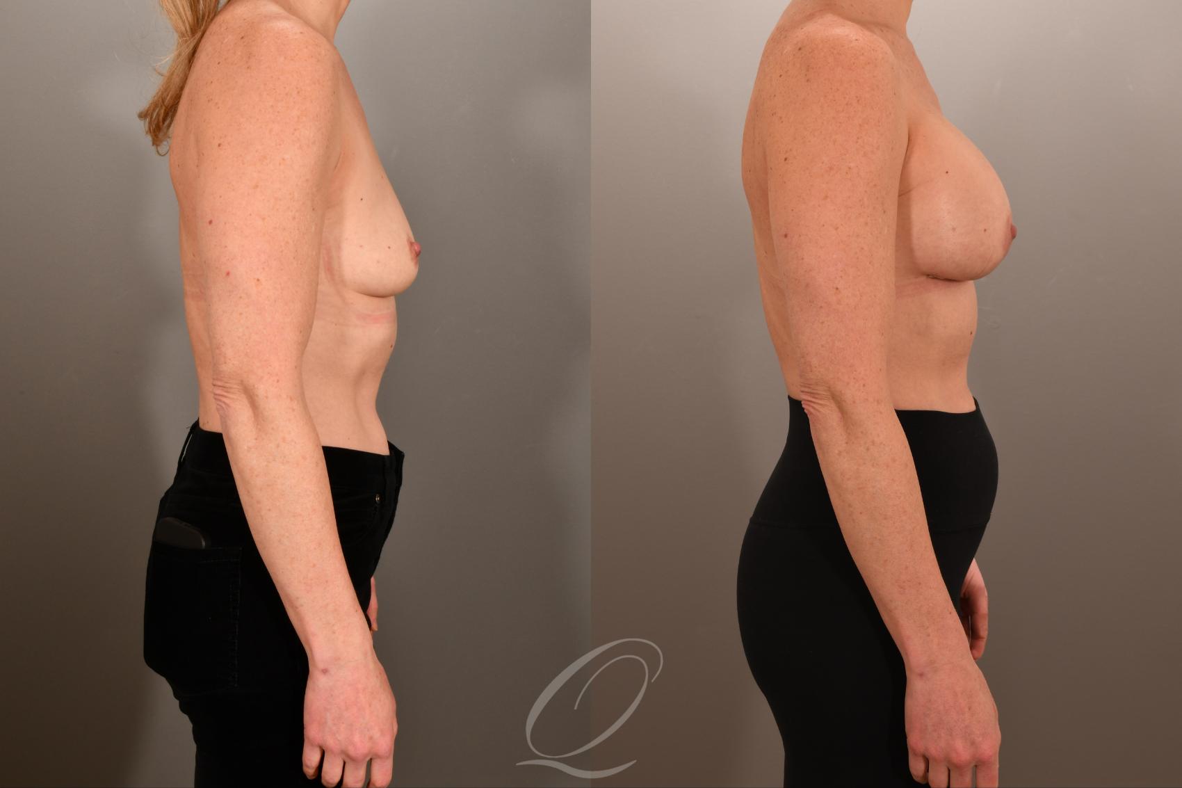 Breast Augmentation Case 1001892 Before & After Right Side | Serving Rochester, Syracuse & Buffalo, NY | Quatela Center for Plastic Surgery