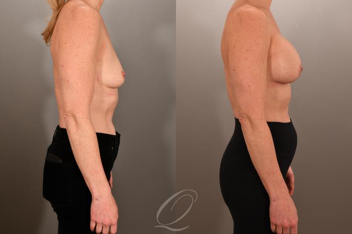 Breast Augmentation Case 1001892 Before & After Right Side | Serving Rochester, Syracuse & Buffalo, NY | Quatela Center for Plastic Surgery