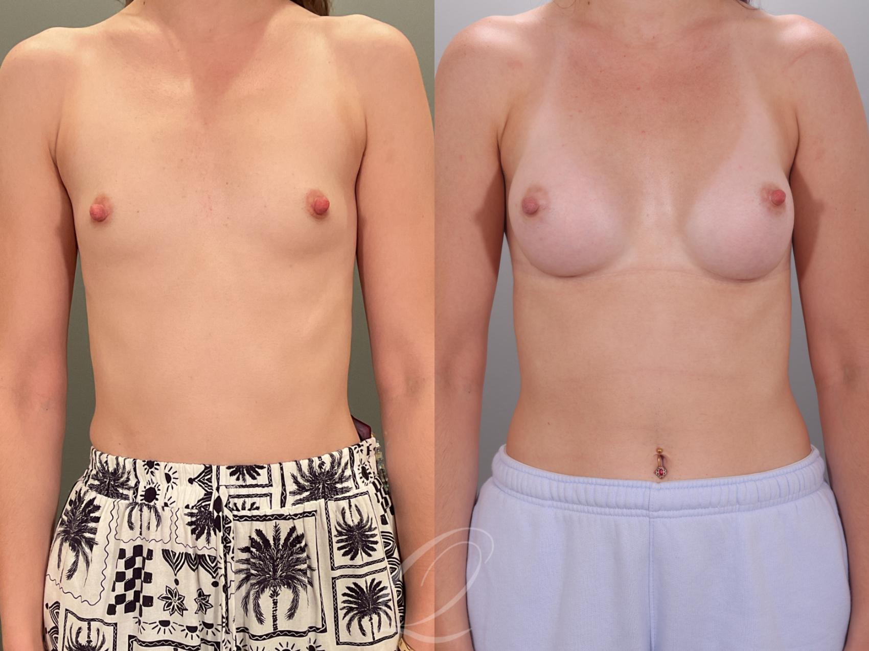 Breast Augmentation Case 1001913 Before & After Front | Serving Rochester, Syracuse & Buffalo, NY | Quatela Center for Plastic Surgery