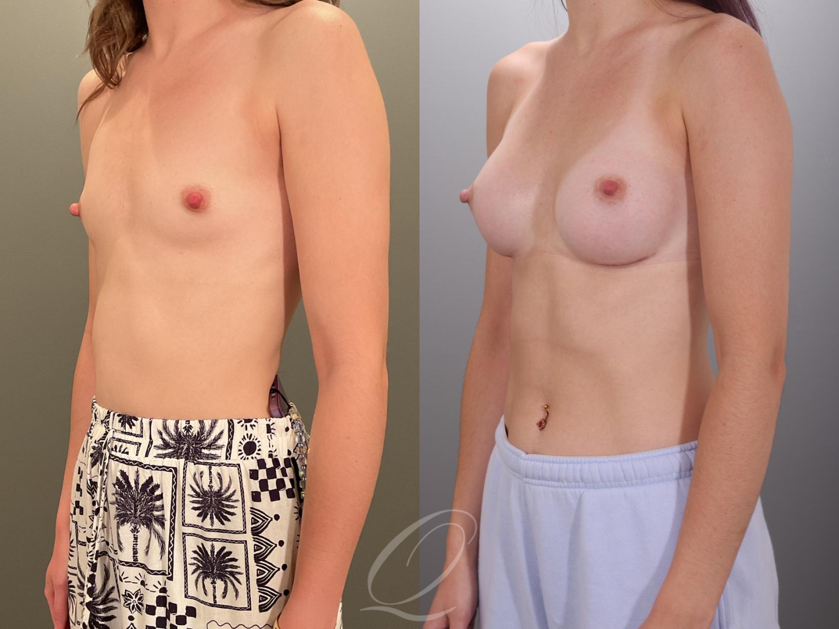 Breast Augmentation Case 1001913 Before & After Left Oblique | Serving Rochester, Syracuse & Buffalo, NY | Quatela Center for Plastic Surgery