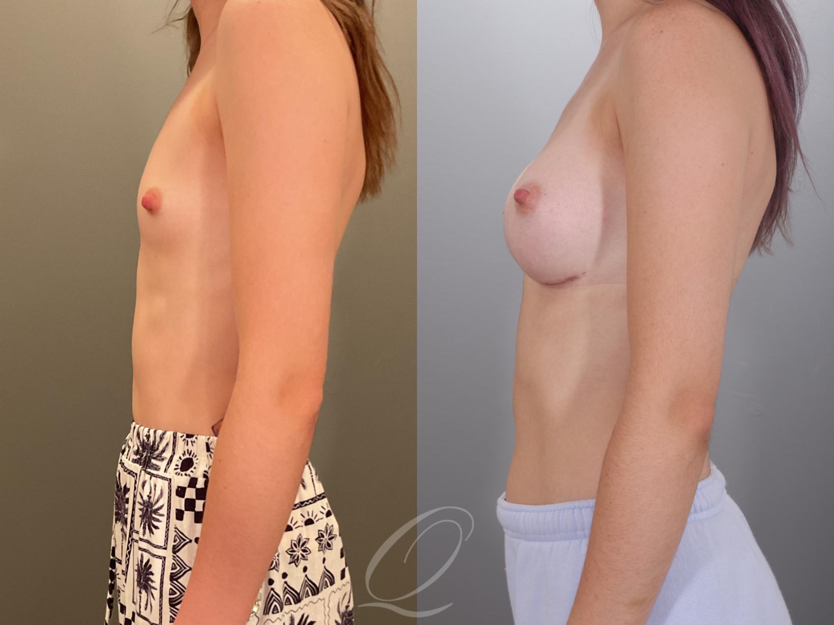 Breast Augmentation Case 1001913 Before & After Left Side | Serving Rochester, Syracuse & Buffalo, NY | Quatela Center for Plastic Surgery