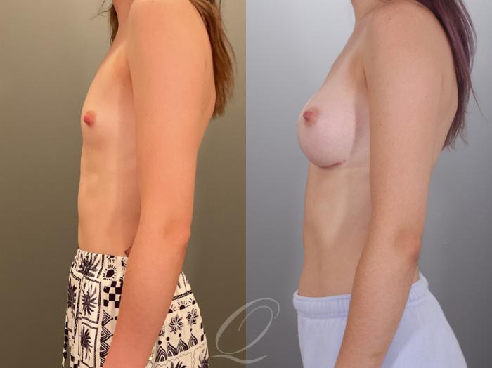 Breast Augmentation Case 1001913 Before & After Left Side | Serving Rochester, Syracuse & Buffalo, NY | Quatela Center for Plastic Surgery
