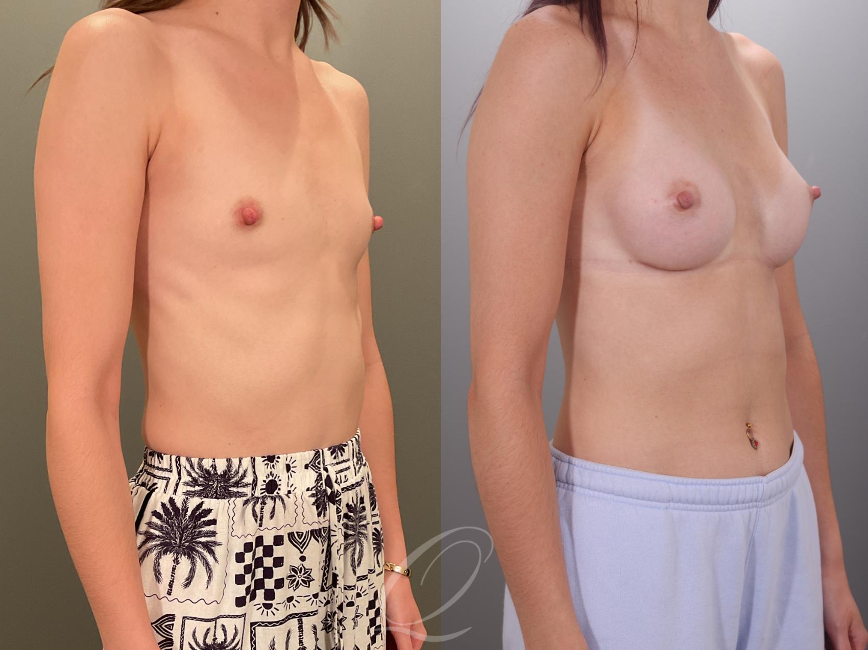 Breast Augmentation Case 1001913 Before & After Right Oblique | Serving Rochester, Syracuse & Buffalo, NY | Quatela Center for Plastic Surgery