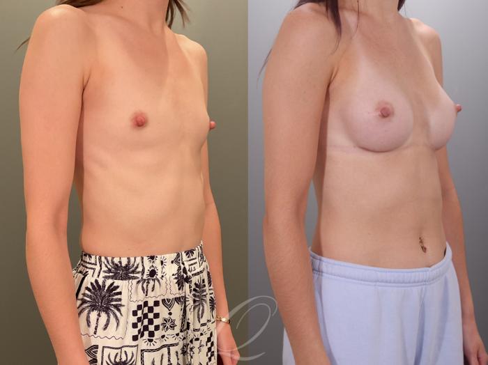 Breast Augmentation Case 1001913 Before & After Right Oblique | Serving Rochester, Syracuse & Buffalo, NY | Quatela Center for Plastic Surgery