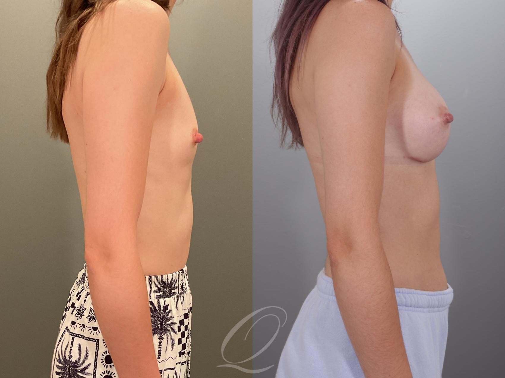 Breast Augmentation Case 1001913 Before & After Right Side | Serving Rochester, Syracuse & Buffalo, NY | Quatela Center for Plastic Surgery