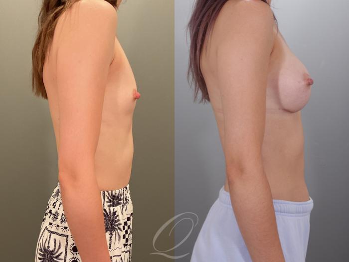 Breast Augmentation Case 1001913 Before & After Right Side | Serving Rochester, Syracuse & Buffalo, NY | Quatela Center for Plastic Surgery