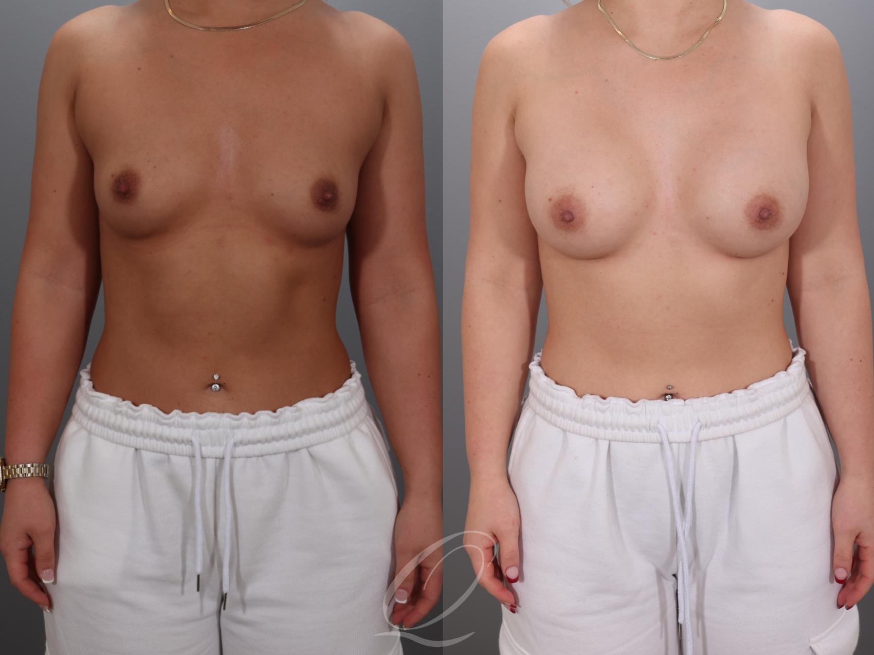 Breast Augmentation Case 1001923 Before & After Front | Serving Rochester, Syracuse & Buffalo, NY | Quatela Center for Plastic Surgery