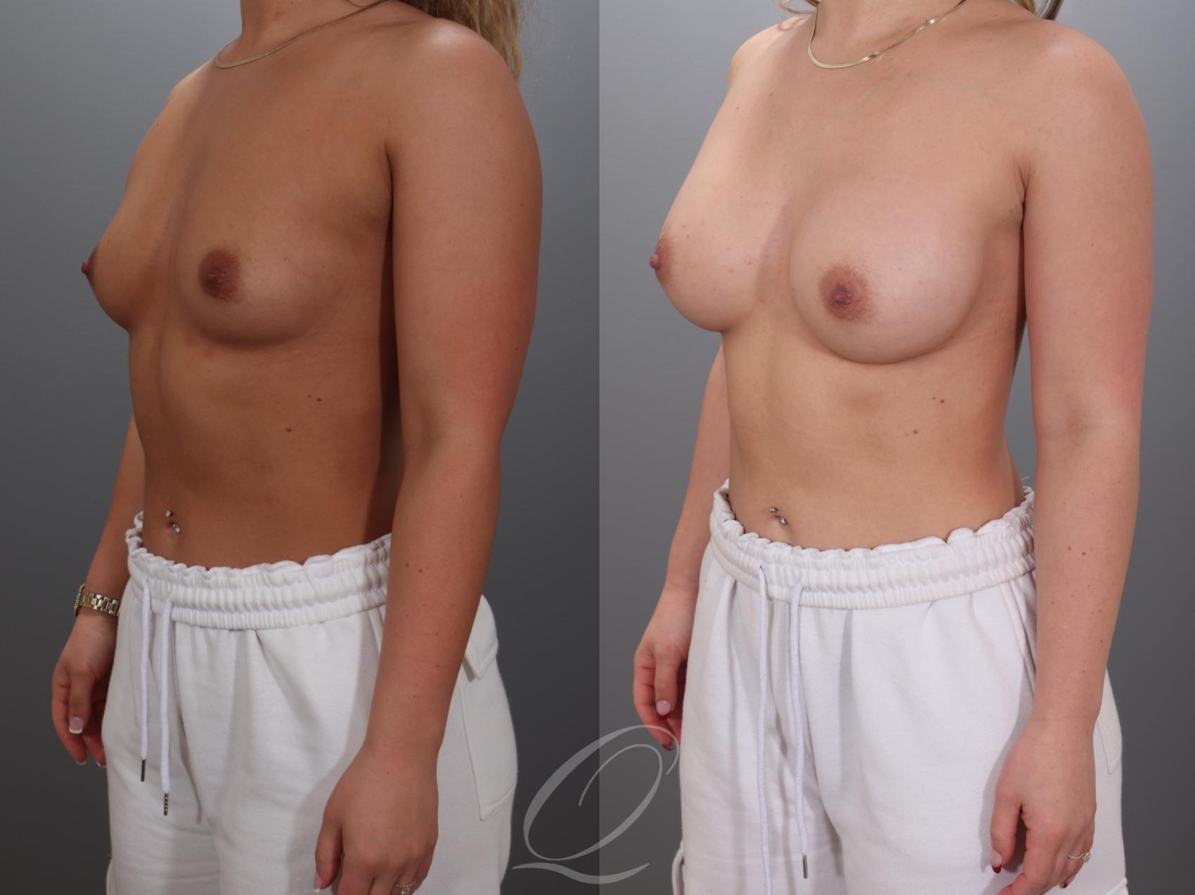 Breast Augmentation Case 1001923 Before & After Left Oblique | Serving Rochester, Syracuse & Buffalo, NY | Quatela Center for Plastic Surgery