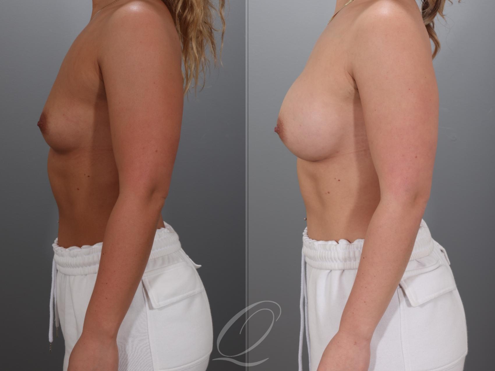 Breast Augmentation Case 1001923 Before & After Left Side | Serving Rochester, Syracuse & Buffalo, NY | Quatela Center for Plastic Surgery