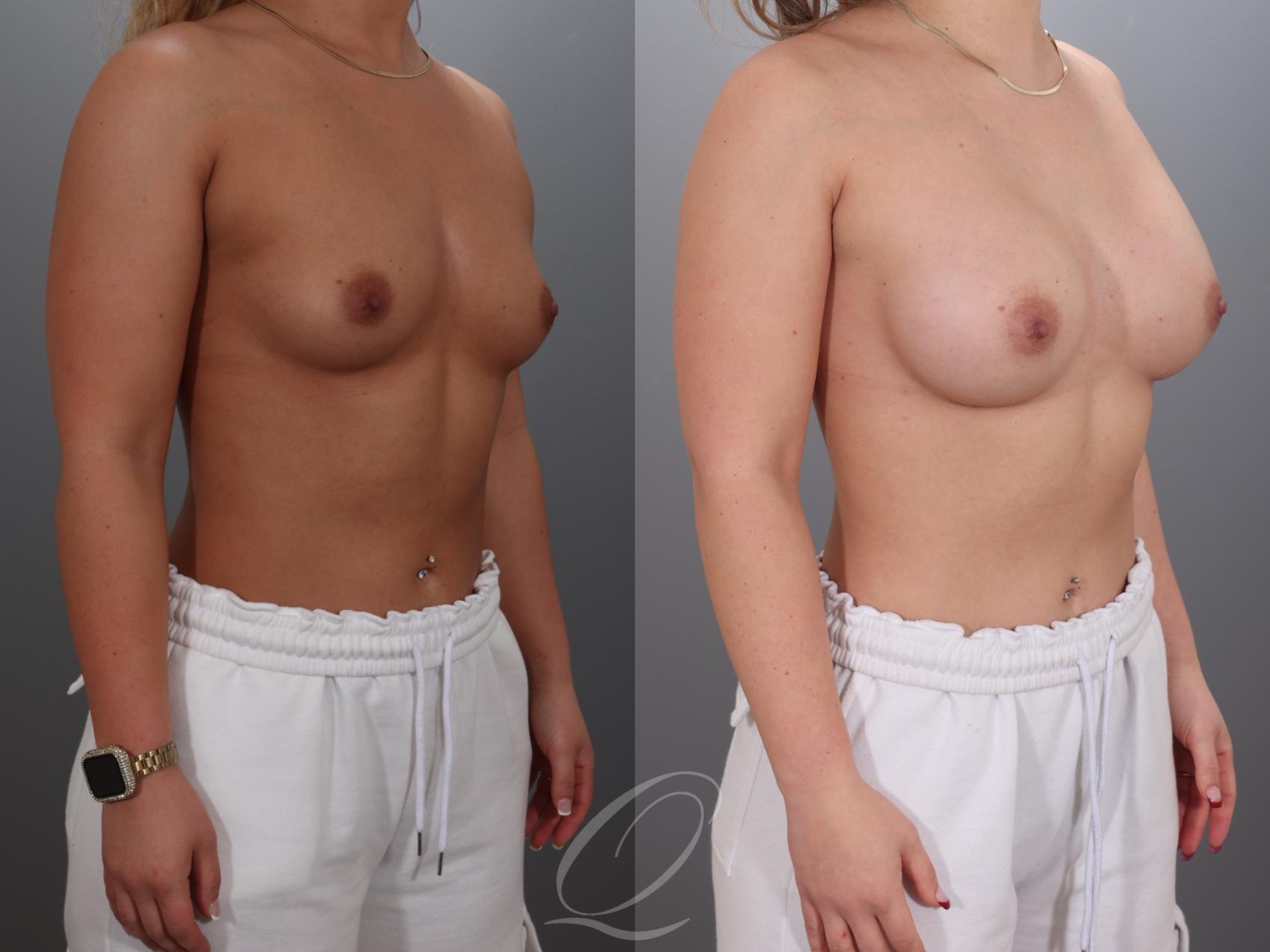 Breast Augmentation Case 1001923 Before & After Right Oblique | Serving Rochester, Syracuse & Buffalo, NY | Quatela Center for Plastic Surgery