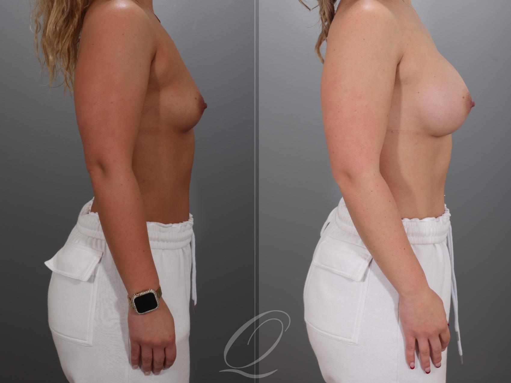 Breast Augmentation Case 1001923 Before & After Right Side | Serving Rochester, Syracuse & Buffalo, NY | Quatela Center for Plastic Surgery