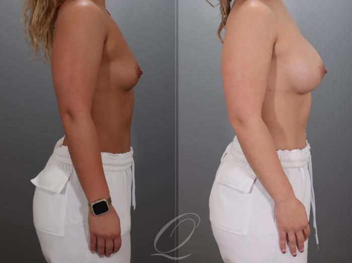 Breast Augmentation Case 1001923 Before & After Right Side | Serving Rochester, Syracuse & Buffalo, NY | Quatela Center for Plastic Surgery