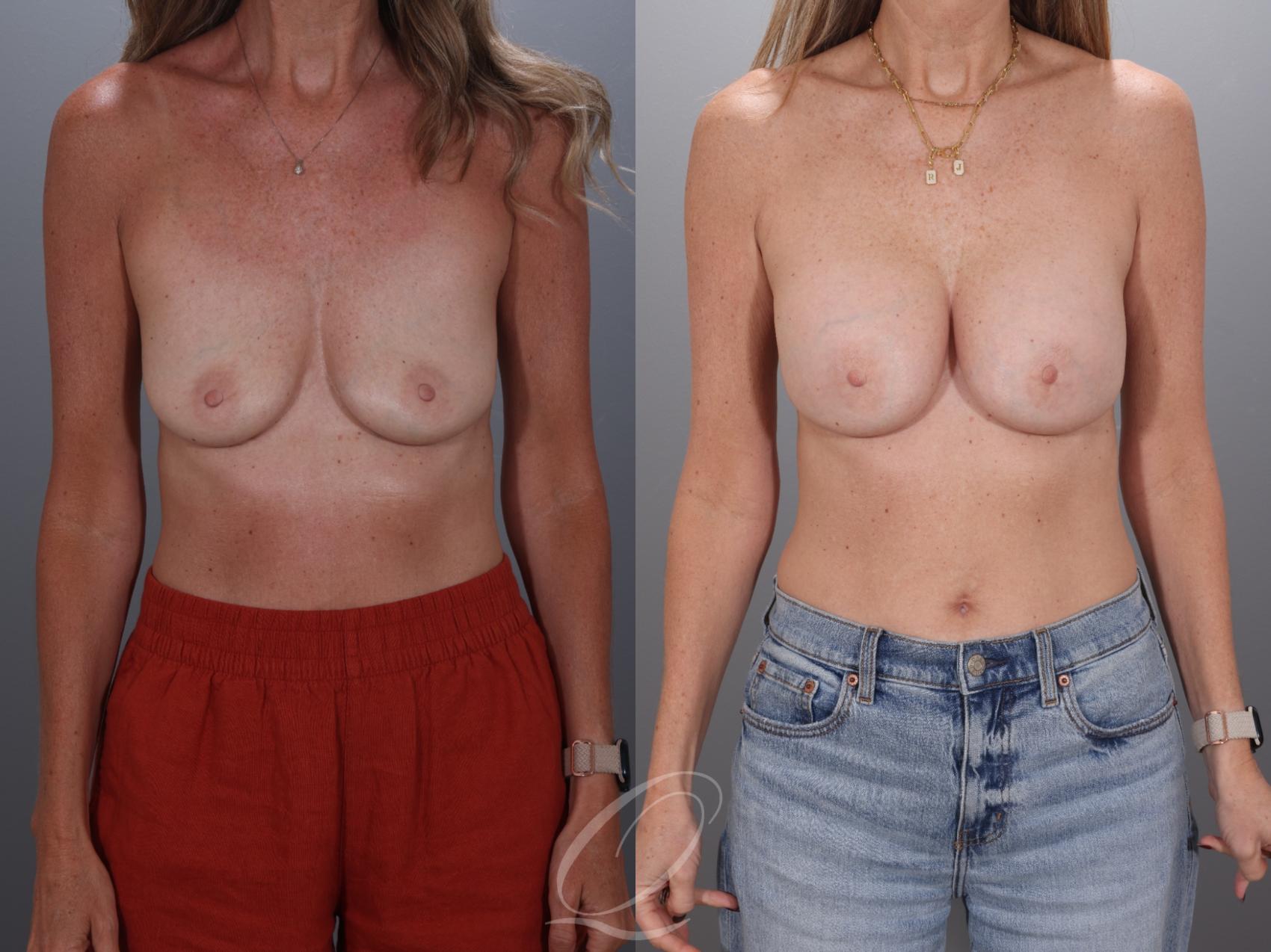Breast Augmentation Case 1001925 Before & After Front | Serving Rochester, Syracuse & Buffalo, NY | Quatela Center for Plastic Surgery
