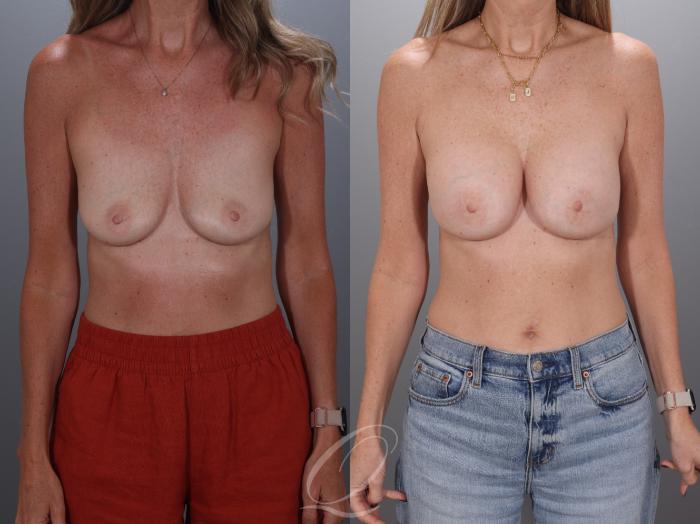 Breast Augmentation Case 1001925 Before & After Front | Serving Rochester, Syracuse & Buffalo, NY | Quatela Center for Plastic Surgery
