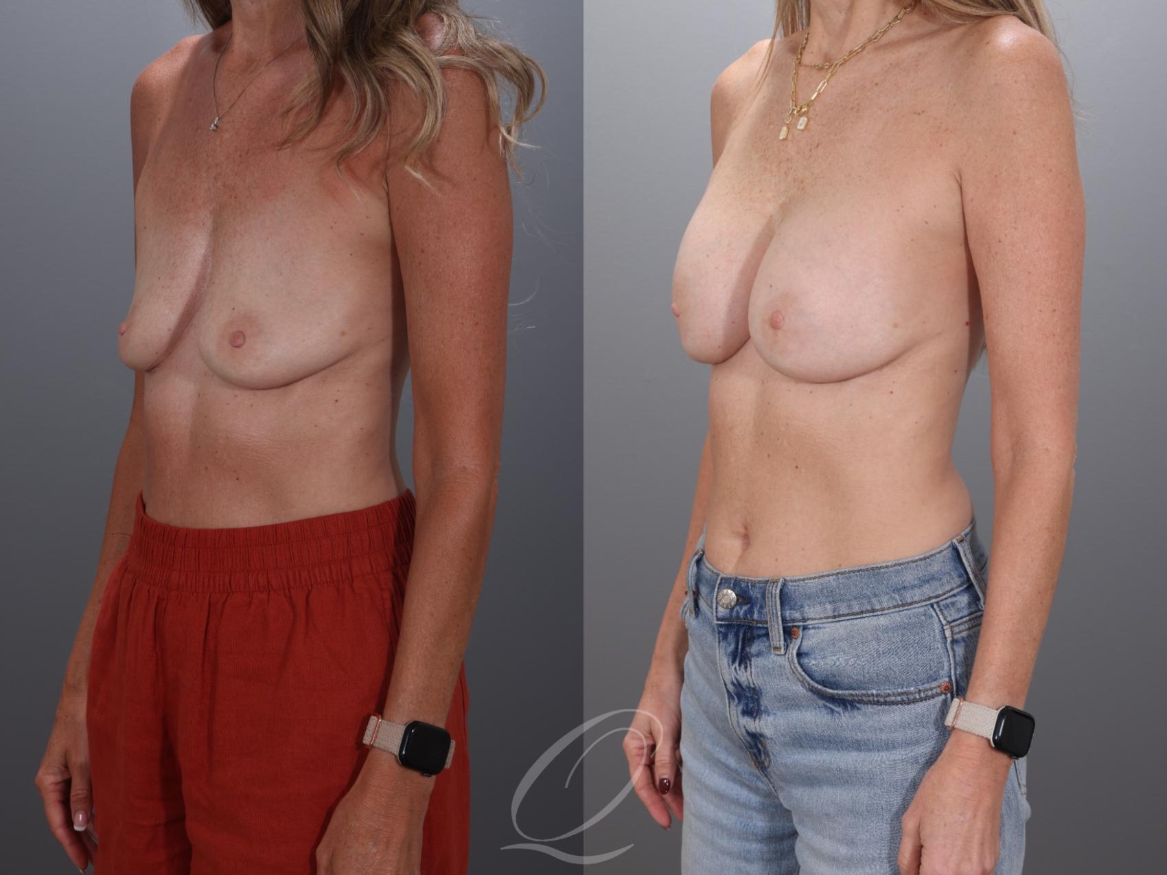 Breast Augmentation Case 1001925 Before & After Left Oblique | Serving Rochester, Syracuse & Buffalo, NY | Quatela Center for Plastic Surgery