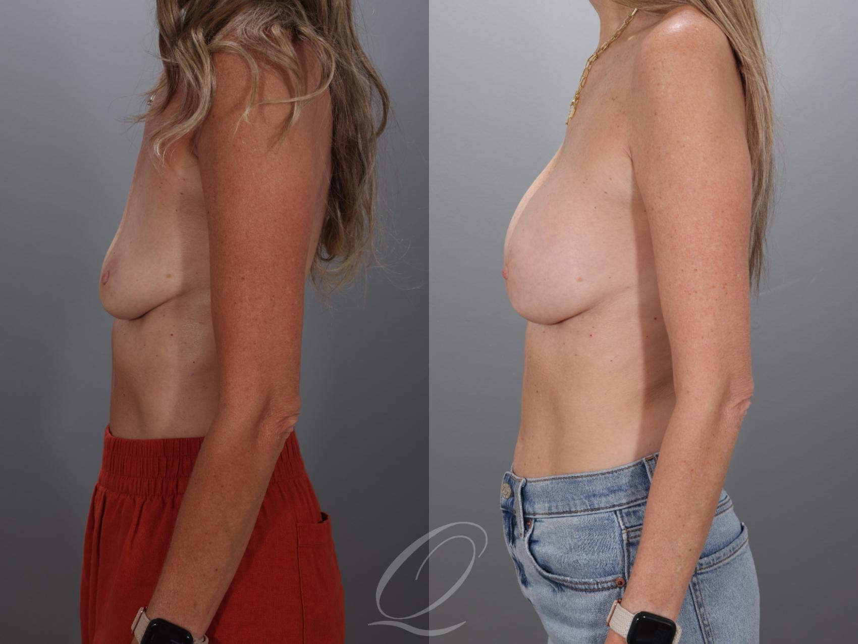 Breast Augmentation Case 1001925 Before & After Left Side | Serving Rochester, Syracuse & Buffalo, NY | Quatela Center for Plastic Surgery