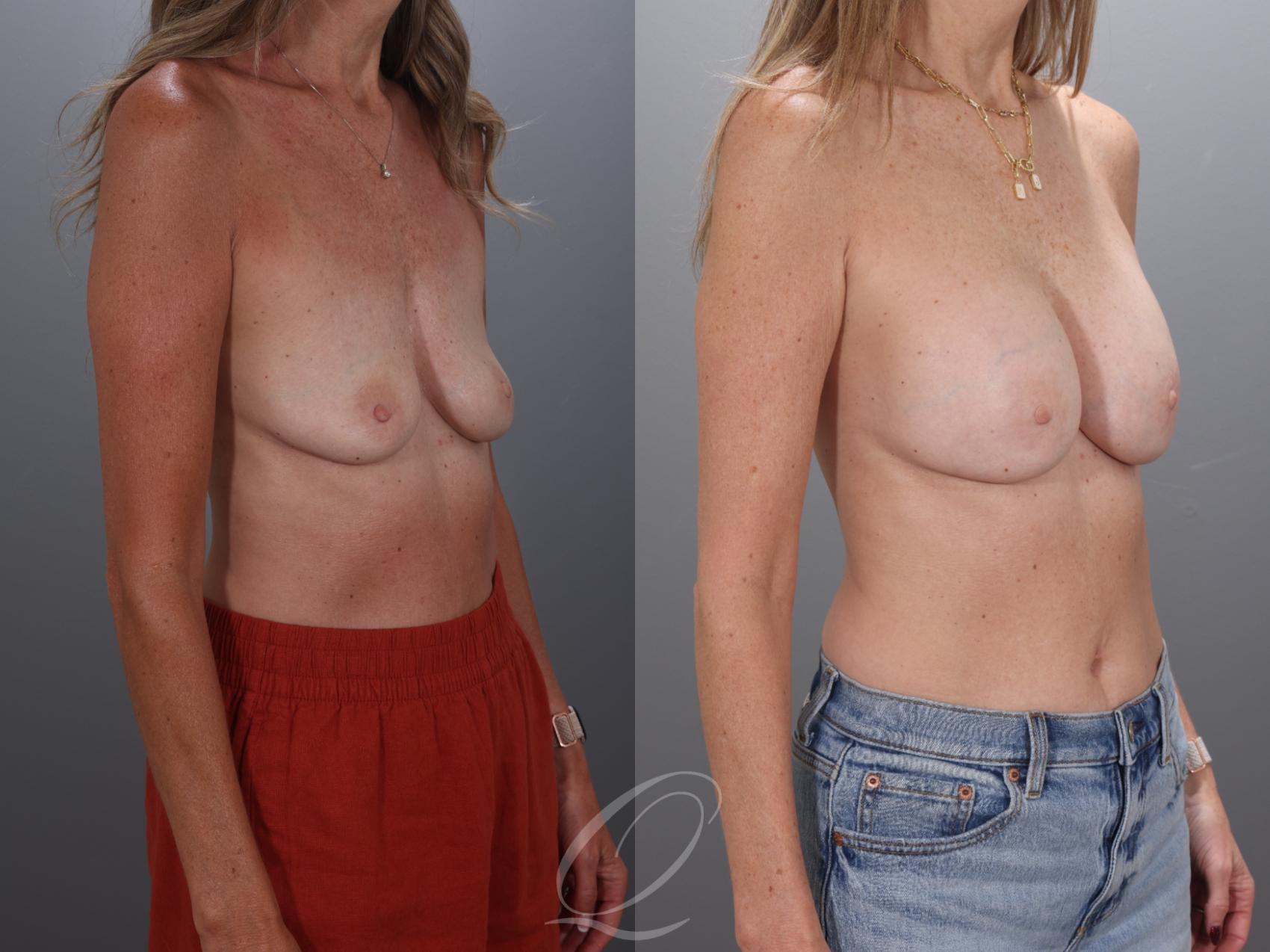 Breast Augmentation Case 1001925 Before & After Right Oblique | Serving Rochester, Syracuse & Buffalo, NY | Quatela Center for Plastic Surgery