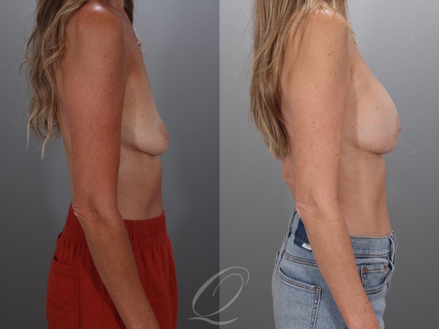 Breast Augmentation Case 1001925 Before & After Right Side | Serving Rochester, Syracuse & Buffalo, NY | Quatela Center for Plastic Surgery