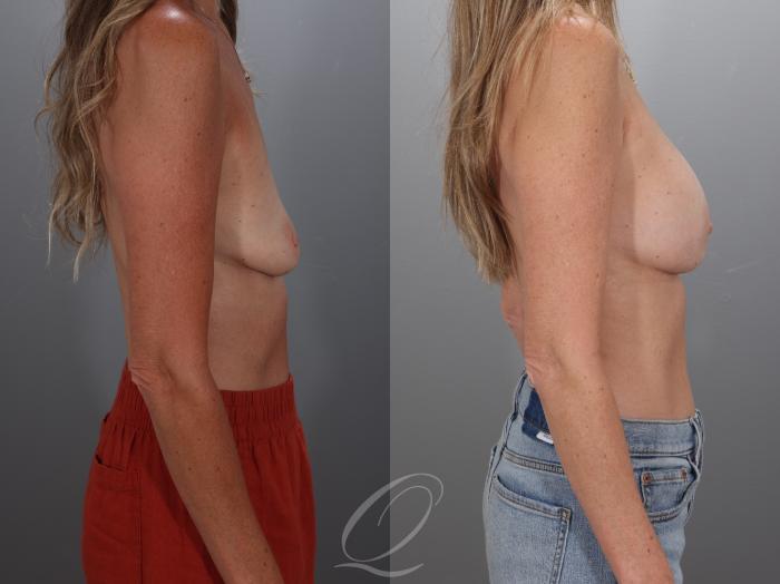 Breast Augmentation Case 1001925 Before & After Right Side | Serving Rochester, Syracuse & Buffalo, NY | Quatela Center for Plastic Surgery