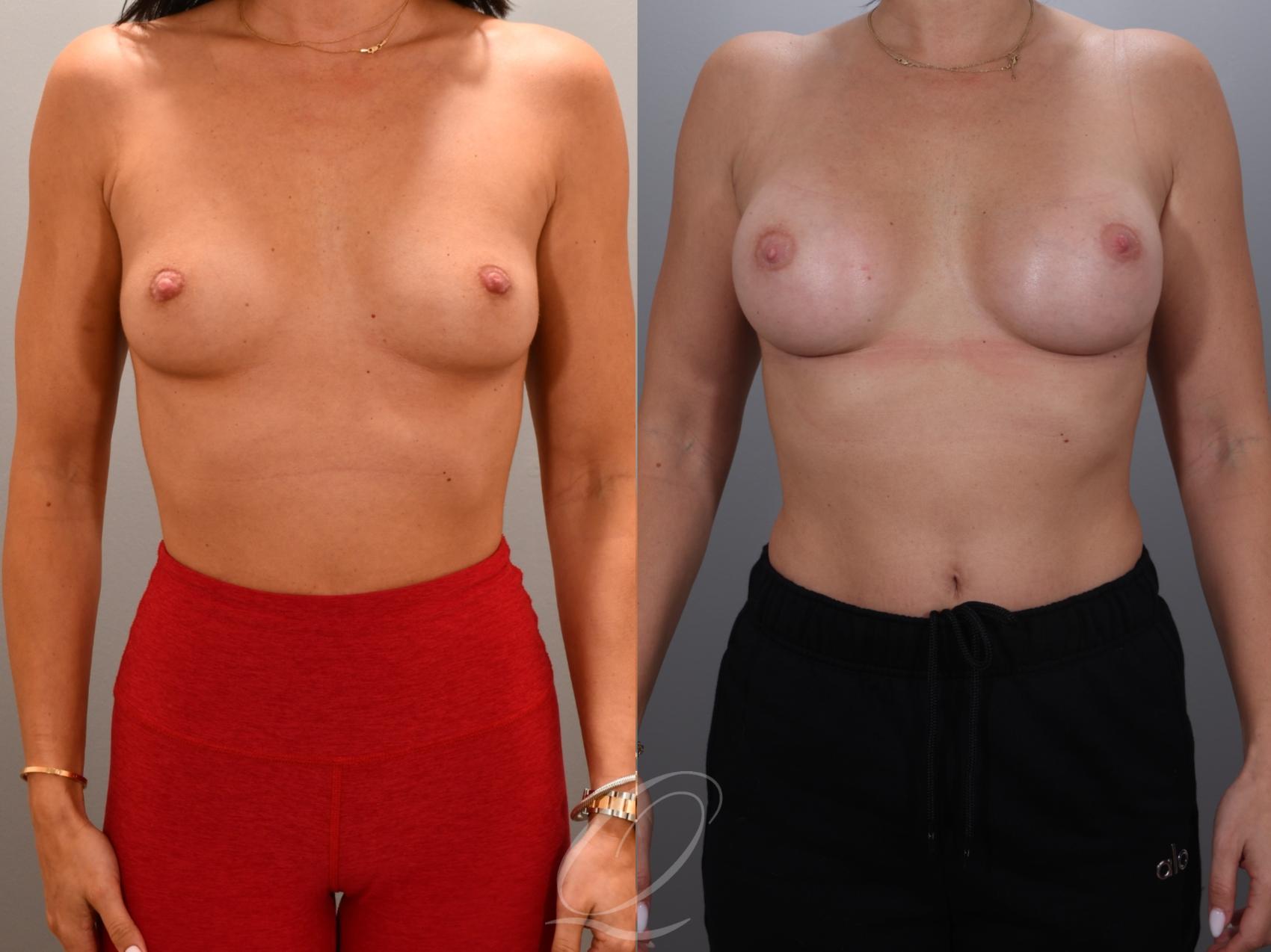 Breast Augmentation Case 1001931 Before & After Front | Serving Rochester, Syracuse & Buffalo, NY | Quatela Center for Plastic Surgery