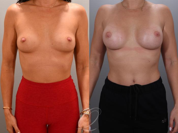 Breast Augmentation Case 1001931 Before & After Front | Serving Rochester, Syracuse & Buffalo, NY | Quatela Center for Plastic Surgery